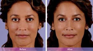 Juvederm
