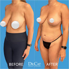 Breast Reduction