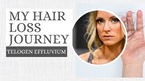 MY HAIR LOSS JOURNEY