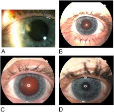 For example, with mild discomfort from a corneal scratch, artificial tear drops may be the only treatment. A And B Small Corneal Ulcer And Adjacent Keratitis On Day 3 C Download Scientific Diagram