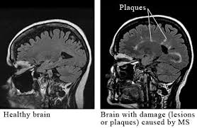 M S Is Different For Every Person Because We Have No Control Over What Part Of The Nerve O Multiple Sclerosis Multiple Sclerosis Awareness Autoimmune Disorder