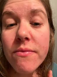 What to use for skin rash