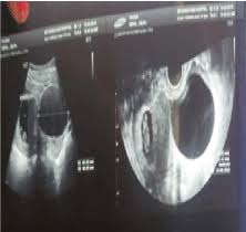 Pausal women found that tumors e xceeding 10. Ovarian Tumor Diagnosed During Pregnancy Their Management