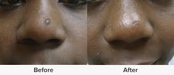 Blend sandalwood powder, rose water, and lemon juice together in a bowl and make an even paste. Mole Removal Scar Healing And Treatments