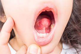 Maybe you would like to learn more about one of these? Sohati Ø­Ø¨ÙˆØ¨ Ø§Ù„Ù„Ø³Ø§Ù† Ø¹Ù†Ø¯ Ø§Ù„Ø£Ø·ÙØ§Ù„