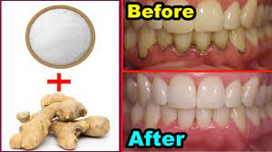 How much does a deep teeth cleaning cost? Get Whiten Teeth At Home In 2 Minutes Teeth Whitening Remedy With Ginger And Salt Youtube