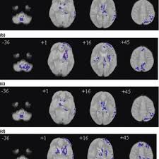A functional mri study of embedded figures task performance.// brain.— Pdf Distinct Patterns Of Grey Matter Abnormality In High Functioning Autism And Asperger S Syndrome