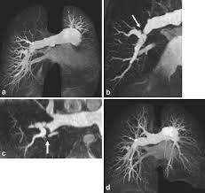 Chronic thromboembolic pulmonary hypertension — assessment by magnetic  resonance imaging