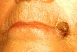 Image result for cornu cutaneum)