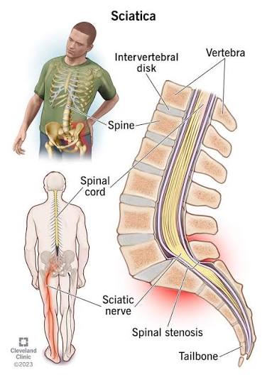Sciatica pain travelling from the lower back through the leg