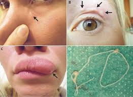 News doctor finder has compiled extensive information in each doctor's profile, including dr. News 4 Tucson Kvoa A Woman Mystified By Itchy Moving Lumps On Her Face Got A Surprising And Somewhat Horrifying Diagnosis They Were Made By A Worm Http Www Kvoa Com Story 38488914 Moving Lump In Womans Face Was A Worm Doctors Say Facebook