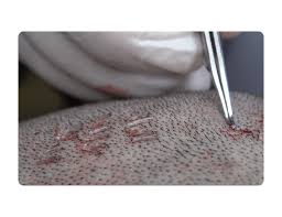 EXTRACTION OF FOLLICLES IN HAIR TRANSPLANTATION | Long Hair Center | Long  Hair Center