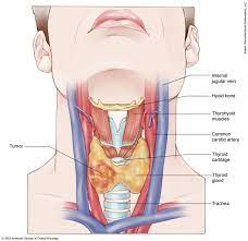 If your thyroid cancer is considered higher risk, meaning it's likely spread (metastasized) beyond the boundaries of the gland, then your doctor will likely although it kills cells (both cancerous and normal types), it also increases the risk of mutation in surviving cells, which can lead to new types of cancer. Thyroid Cancer Stages Cancer Net