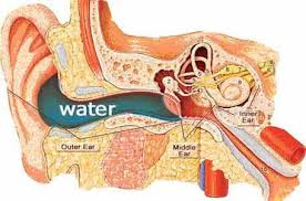Swimmer S Ear Also Known As Otitis Externa Is An Infection Of The Outer Ear Canal That Can Cause Pa Swimmers Ear Swimmers Ear Home Remedy Swimmers Ear Remedy