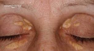 Image result for xanthelasma of eyelid