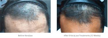 As the drug transitions more and more of your hairs into the active anagen growth phase, more and more of. New Keralase Hair Stimulation For Hair Loss Ron Shelton M D