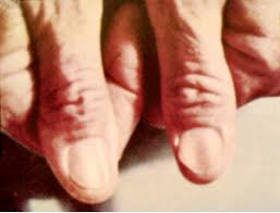 Image result for Koilonychia feet