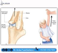 Image result for Radial Head Dislocation