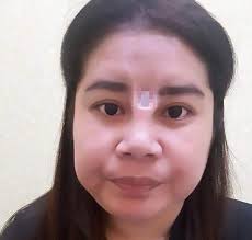 Operasi plastik kerap menjadi pilihan instan bagi sebagian orang untuk. Operasi Hidung Gagal Yang Terjadi Pada Wanita Ini Sungguh Mengerikan Lifestyle Fimela Com
