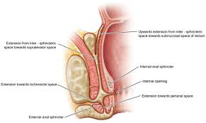 Image result for Ischiorectal Abscess