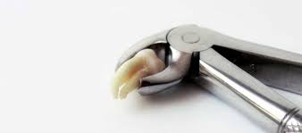 Image result for Alveolitis sicca)