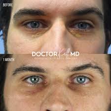 Image result for xanthelasma of eyelid