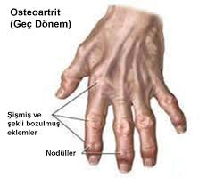 parmaklarda kireclenme ve tedavisi artrit saglikli yasam egzersiz