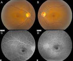 Pin On Sjogren S