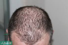 زراعة الشعر في الرياض موقع للرجال فقط