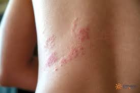 Recombinant zoster (shingles) vaccine can prevent shingles. Shingles Epiphany Dermatology