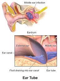 Maybe you would like to learn more about one of these? Managing Middle Ear Fluid In Adults Tinnitus Treatment Hearing Aids Hearing Loss Rochester Ny