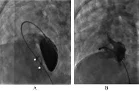 Multimodality Imaging Of Right Ventricular Outflow Tract Disease In Adults  With Congenital Heart Disease | Springerlink