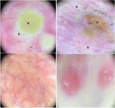 This is called metastatic breast cancer (mbc). Dermoscopy Of Skin Metastases From Breast Cancer Two Case Reports Journal Of Medical Case Reports Full Text