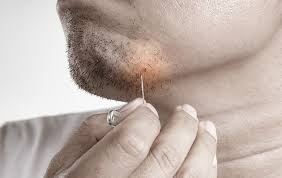 Sometimes you can see a hair trapped under infected ingrown hairs can be painful. Using Laser Hair Removal To Eliminate Ingrown Hair Vibrance Medspa