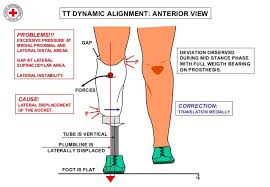 Transtibial Dynamic Alignment Dynamic Alignment Nursing School Notes