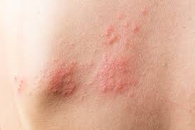 Image result for Hives