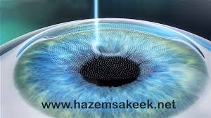 You may begin your bachelor's degree on any of our campuses. ÙƒÙŠÙ ØªØ¹Ù…Ù„ ØªÙ‚Ù†ÙŠØ© Ø§Ù„Ù„ÙŠØ²Ùƒ Lasik Ø´Ø¨ÙƒØ© Ø§Ù„ÙÙŠØ²ÙŠØ§Ø¡ Ø§Ù„ØªØ¹Ù„ÙŠÙ…ÙŠØ© Laser Eye Surgery Lasik Eye Surgery Eye Surgery