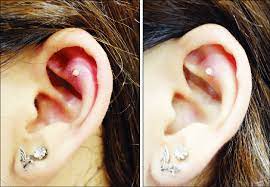 Local Infection Without Granuloma After Helix Piercing Result One Week Download Scientific Diagram