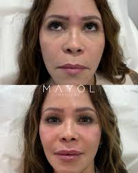 Luis Xavier Mayol Vélez, MD, MPH (@drmayol) • Instagram photos and videos