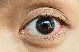 Blut Im Auge Sind Geplatzte Adern Im Auge Gefahrlich Dr Stephan