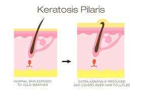 Actinic keratosis is the most prevalent condition affecting. Does Keratosis Pilaris Cause Hair Loss Quora