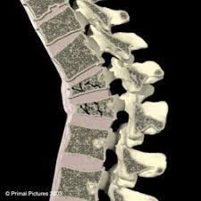Image result for Vertebral Compression Fracture