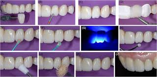 Maybe you would like to learn more about one of these? Chipping Of Veneering Ceramic On A Lithium Disilicate Anterior Single Crown Description Of Repair Method And A Fractographic Failure Analysis Garbelotto 2019 Journal Of Esthetic And Restorative Dentistry Wiley Online Library