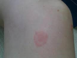 Image result for Erythema Multiforme