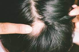 Alopecia areata is a condition where patches of hair loss develop, usually on the head. Kreisrunder Haarausfall Ursachen Behandlung
