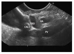 The condition can result from gallstone disease. Imaging Of Gall Bladder By Endoscopic Ultrasound