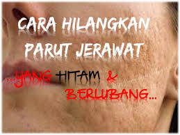 Pagesbusinessesshopping & retailnad beauty housevideostips nak hilangkan jerawat dan parut dalam masa 1 hari. Cara Hilangkan Parut Jerawat Berkawah Dan Hitam Bebelsihat Com