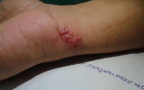 Itchy bumps on buttock may be due to the hives brought on by a variety of reasons, such as scented toilet paper, soaps, clothes, etc.read more. Recurrent Extragenital Herpes Simplex Type 2 Occurring In A Distal Location Of The Same Dermatome Sciencedirect