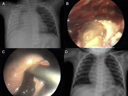Image result for Lung Abscess