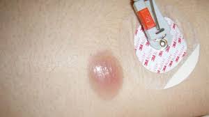 There may be enough blood to change the color of the urine to. Leukemia Rash Pictures Symptoms And When To See A Doctor